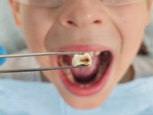 Best Broken or Chipped Tooth Repair in Aurora, MN